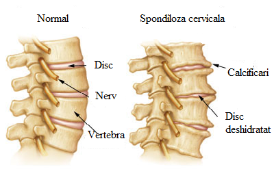 discurile intervertebrale ale coloanei cervicale osteoartrita articulației I metatarsofalangiene