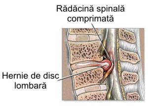 Tratament naturist pentru hernia de disc lombara